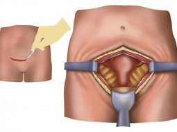 Как проводят перевязку маточных труб: особенности хирургической стерилизации